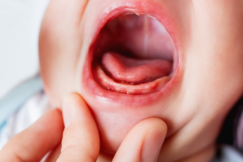 infant-acid-reflux-how-correcting-a-tongue-tie-can-help